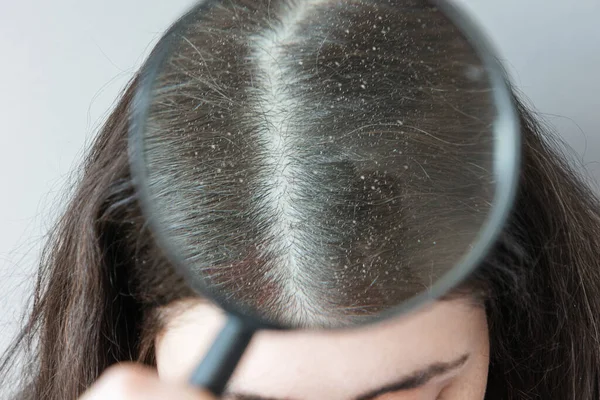 Doctor Shows Close Parting Brunette Hair Head Covered Dandruff View — стоковое фото