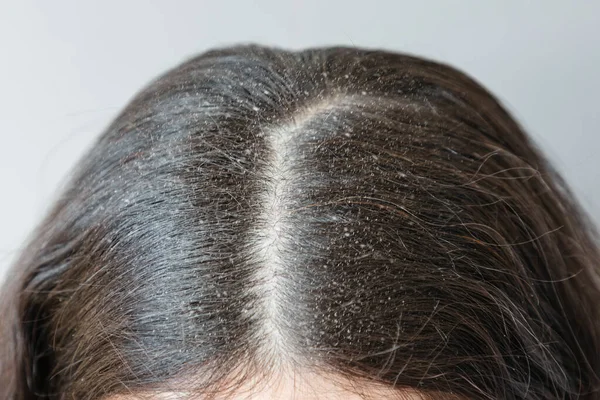 頭の上にブルネットの髪の別れのクローズアップは ダンルフで覆われています 脂漏性皮膚炎の概念 — ストック写真