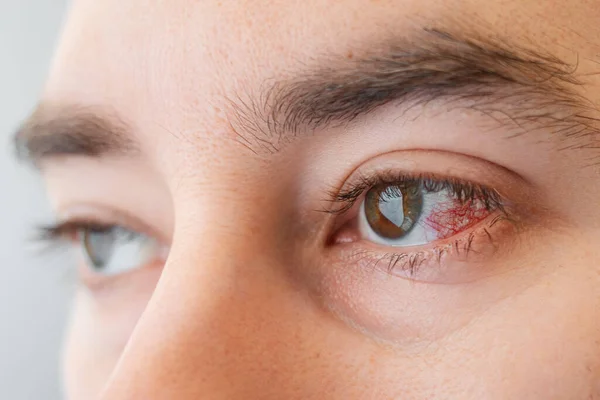 Zbliżenie Męskich Brązowych Oczu Zaczerwienieniem Pęknięciem Naczyń Koncepcja Okulistyki Podrażnienia — Zdjęcie stockowe