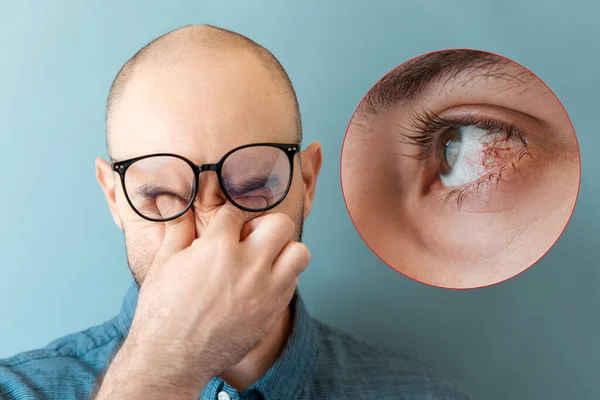 Caucasian bald man lift his glasses and scratches his eyes. Close-up of the eye with irritation, redness and vascular mesh. Concept of vision problems and ophthalmology.
