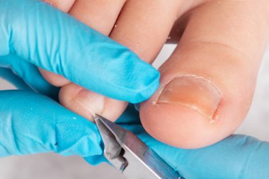 A chiropodist gives a pedicure to the client's feet, cutting dry skin with clippers. Close up. The concept of foot care and chiropody.