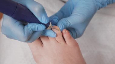 Mavi eldivenli bir podolojist tırnak tırnağı parmaklarını aşındırıcı bir başlıklı mekanik bir aletle parlatıyor. Yakın çekim, üst görüş. Ayak ve ayak hastalıkları konsepti..
