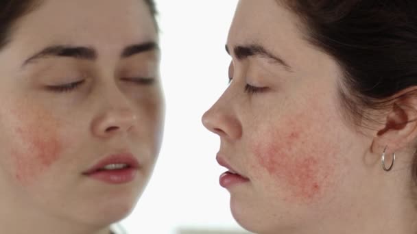 Close Young Caucasian Woman Rosacea Her Cheeks Looking Her Reflection — Stock Video