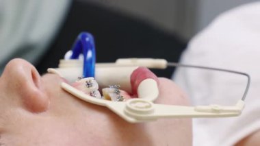 Diş retraktörü olan bir kadına yakın çekim. Ortodontist, müşterinin dişlerindeki bağlama tellerini tamir ediyor. Diş hekimliği ve stomatoloji kavramı