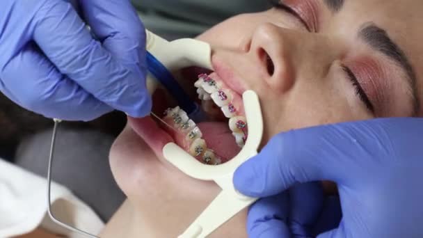 Tıbbi Eldivenli Ortodontist Hastanın Dişlerine Teli Takıyor Kadın Yüzünün Üst — Stok video