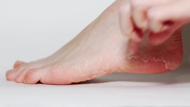 Zbliżenie Kobiecej Nogi Oczyszczającej Dłoni Łuszczącej Skórę Białym Tle Pojęcie — Wideo stockowe