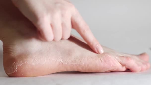 Detailní Záběr Ženské Nohy Ruky Ukazující Olupování Kůže Dermatitida Ekzém — Stock video