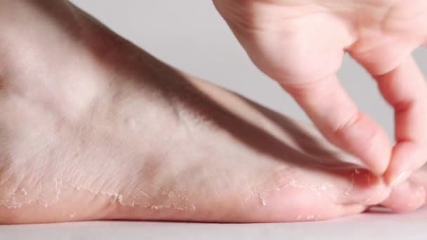 Дерматит Экзема Крупный План Женской Ноги Руки Очищает Кожу Концепция — стоковое видео