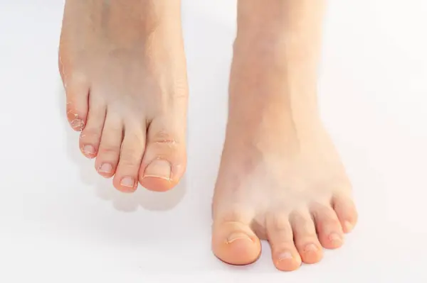 Close-up of woman\'s legs with flaky skin on toes. White background. Concept of pedicure and cosmetology.