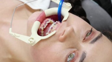 Diş hekimliği kliniğindeki randevusunda diş telleri takılı beyaz bir kadının fotoğrafını çek. Maloklasiyonun ortodontik düzeltilmesi. Ortodontik tedavi ve stomatoloji kavramı