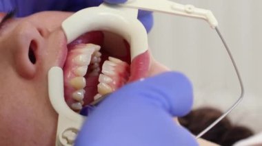  Dişçi dişleri tedavi eder. Diş tedavisiyle ilgili diş retraktörü olan genç bir kadına yakın çekim. Diş hekimliği ve stomatoloji kavramı