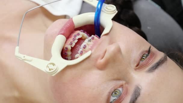 Крупный План Белой Женщины Назначении Стоматологическую Клинику Брекетами Зубах Ортодонтическая — стоковое видео