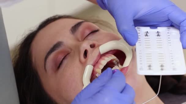 在牙科诊所接受预约的白人妇女的近视 其牙齿上有韧带支撑 正畸矫正错牙合 牙齿矫正治疗的概念 — 图库视频影像