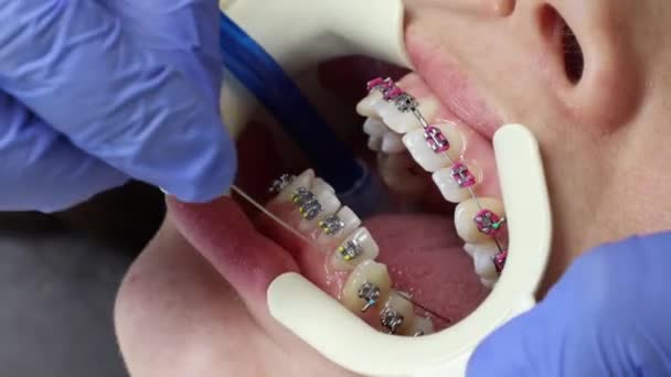 Orthodontist Medical Gloves Installs Arc Ligature Braces Client Teeth Concept — Stock Video