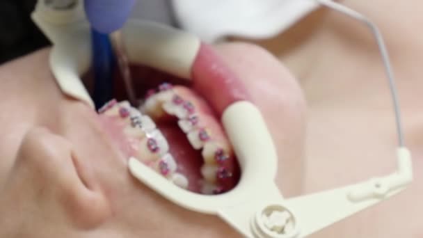 Ортодонт Устанавливает Лигатурную Кронштейн Систему Женские Зубы Вид Крупным Планом — стоковое видео