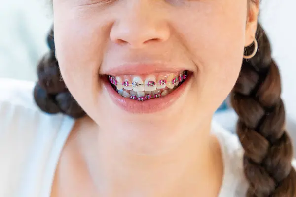 Крупним Планом Усміхнена Молода Жінка Брекетами Білих Зубах Концепція Ортодонтії Стокове Зображення