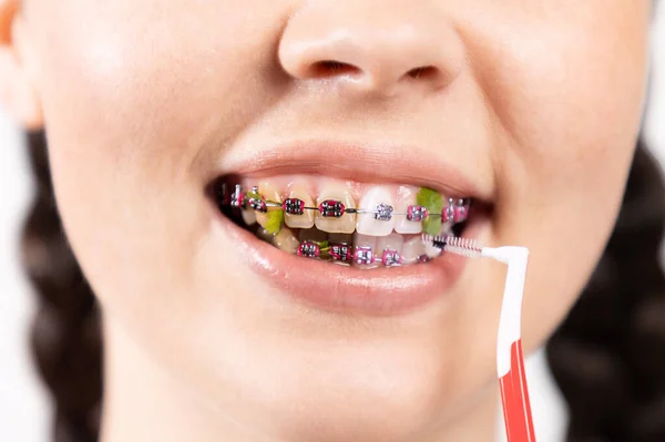 Close up of young Caucasian woman with brackets on dirty teeth cleaning interdental space using orthodontic toothbrushes. Before and after cleaning. Concept of dental care during orthodontic treatment.