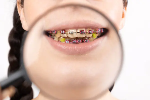 Zbliżenie Młodej Białej Kobiety Wspornikami Brudnych Zębach Widok Zoomu Przez Obrazy Stockowe bez tantiem