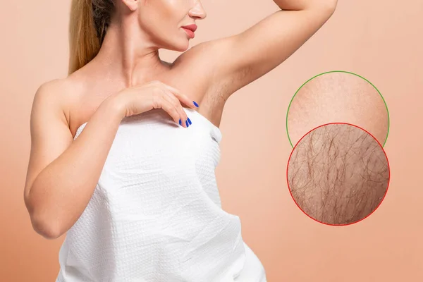 stock image Caucaisan woman showing the smooth skin of her armpits. Enlarged area with results before and after depilation procedures. Beige background. The concept of photoepilation and laser hair removal.