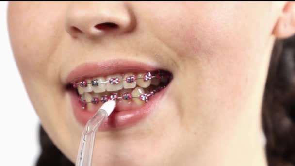 リガーブレースを持つ若い白人女性の近くにモンペクルブラシを使用して歯を磨きます 矯正治療と歯科医療の概念について — ストック動画