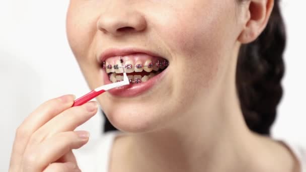 Zbliżenie Młodej Białej Kobiety Nawiasami Czyszczącej Zęby Ortodontycznymi Szczoteczkami Zębów — Wideo stockowe