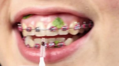 Kadının ağzının kapağı kirli dişlerini gösteriyor ve fırçayla temizliyor. Ortodontik tedavi ve hijyen kavramı