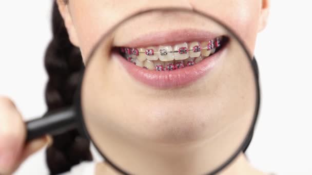 Büyüteç Tutan Yakınlaştırılmış Dişlerini Telleriyle Gösteren Kadının Yakın Çekimi Ortodonti — Stok video