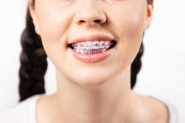 Close up of young Caucasian woman with brackets on teeth and orthodontic wax covering one ligature brace. White background. Concept of dental care during orthodontic treatment.