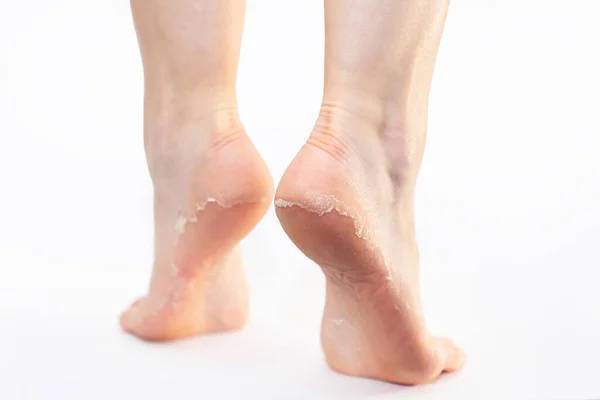Вид Ззаду Жіночі Ноги Лущенням Шкіри Підборах Білому Тлі Догляд Стокове Фото