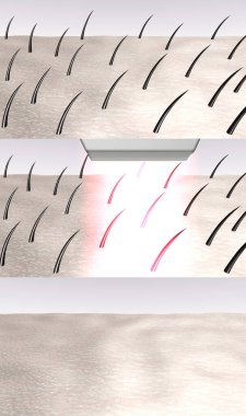 Laser hair removal 3d rendered illustration