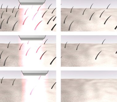 Laser hair removal steps. 3d rendered illustrations set