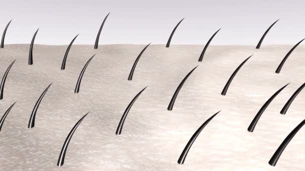 Hair Loss Process Skin Few Steps Laser Hair Removal Procedure — Vídeo de Stock