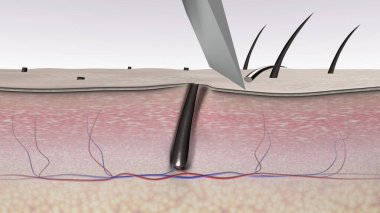Hair shaving with bad results. A razor blade cuts body hair. The 3D-rendered illustration shows the imperfection of hair removal by a razor blade