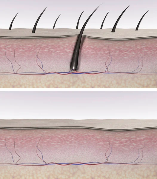 Skin before and after hair removal. Skin tissues and hair follicle cross-section. 3d rendered illustration