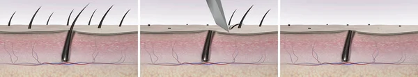 Hair removal illustrations set that show bad results after shaving. 3d renders skin tissues and hair follicle cross-sections before and after cutting hair with a razor blade