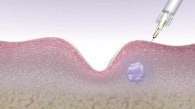 Deri dolgusu ya da hyaluronik asit enjeksiyonuyla cilt sıkışıyor. Bu ilaç kolajen sentezini tetikliyor ve yaşlanmayı önleyen 3D animasyon reklamını, spa prosedürlerini, radyasyon ilacını azaltıyor.