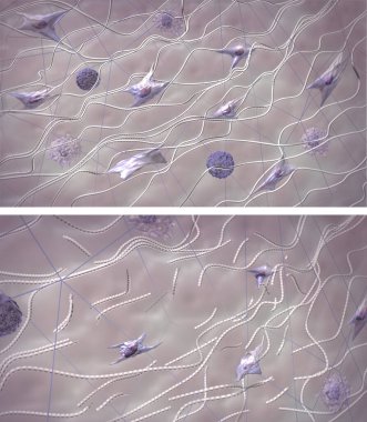Genç, sağlıklı ciltte ve yaşlanan ciltte kolajen lifleri. Yıkım süreci. Deri dışı matris yapısı karşılaştırması. Medikal 3D resimleme
