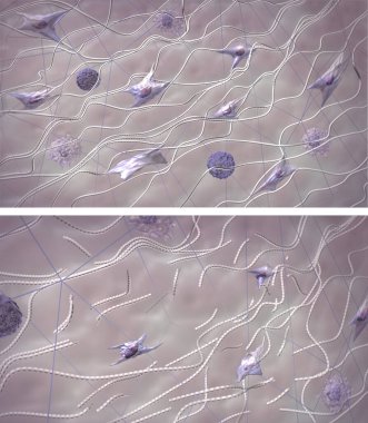Collagen fibers in young healthy skin and aging skin.Destructive process. Comparison of skin extracellular matrix structure. Medical 3D rendered  illustration clipart