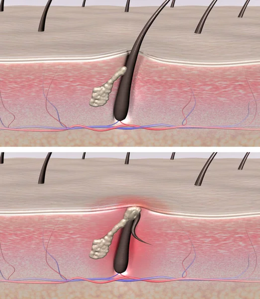 Ingrown hair. Normal and problem skin. 3D rendering of human skin cross-sections showing healthy hair follicles and inflamed with acne and ingrown hair