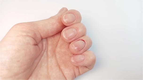 Kvinnan Behandlar Nagelbanden Med Ett Antiseptiskt Medel Och Torkar Det — Stockvideo