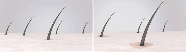 Yağlı ve normal cilt. 3 boyutlu illüstrasyon yağın yağlı bezlerden üretildiğini gösteriyor. Gözenekler saç foliküllerinin etrafındaki yağ ile doluyor ve cilt yağlanıyor. Tedaviden önce ve sonra karşılaştır