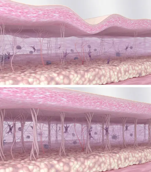 stock image Collagen fibers regeneration in the skin tissues. Wrinkled skin before and smooth skin after anti-aging treatment or cosmetics action. Skin layers, matrix, collagen, elastin fibers, fibroblasts. Comparison of 3D illustrations of young and aged skin 