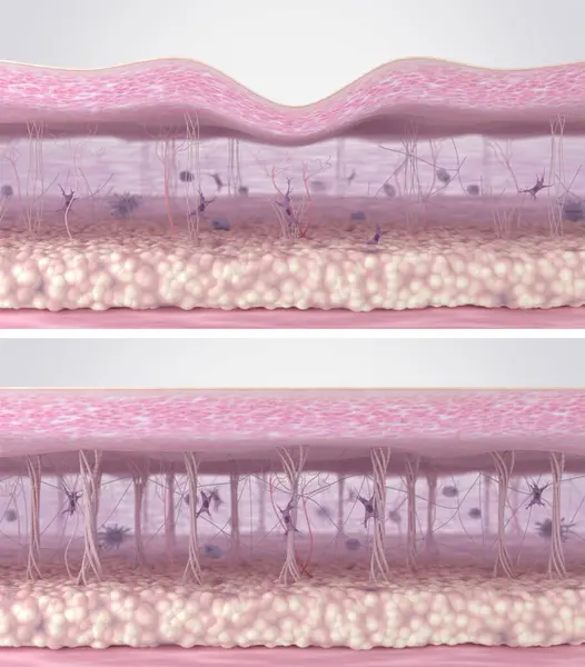 Deri hücre dışı matriste fibroblast aktivasyonu ve kolajen lifleri yenilenmesi. Yaşlanma önleyici kırışıklık azaltma tedavisinden önce ve sonra deri dokularının çapraz kesimi. 3d illüstrasyon