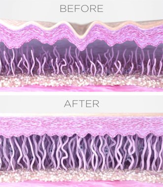 Genç ve yaşlanmış ciltte kolajen lifleri. Deri katmanları yaşlanmayı önleme tedavisinden önce ve sonra kesiliyor. 3 Boyutlu resimleme