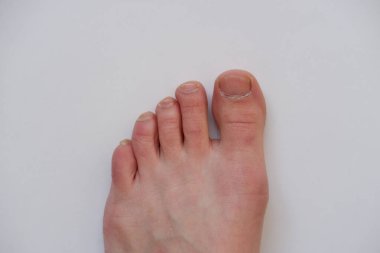 Ayak parmaklarındaki çirkin manikür beyaz arka planda. dağınık ve kirli tırnaklar