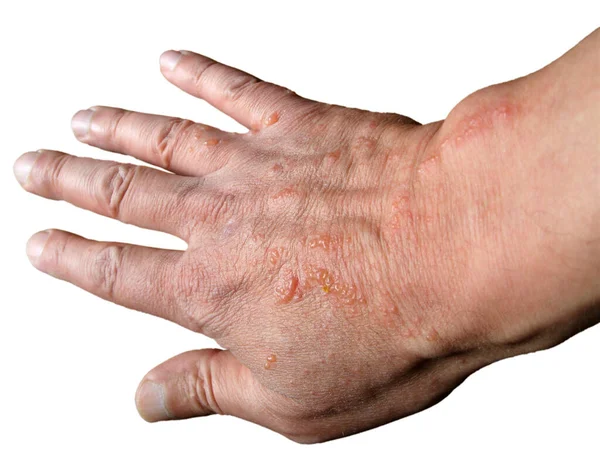 Chemical burn of the skin from hogweed. Man\'s hand has suffered from dangerous plant burn known as cow parsnips or giant cow parsley - the palm is on white background.