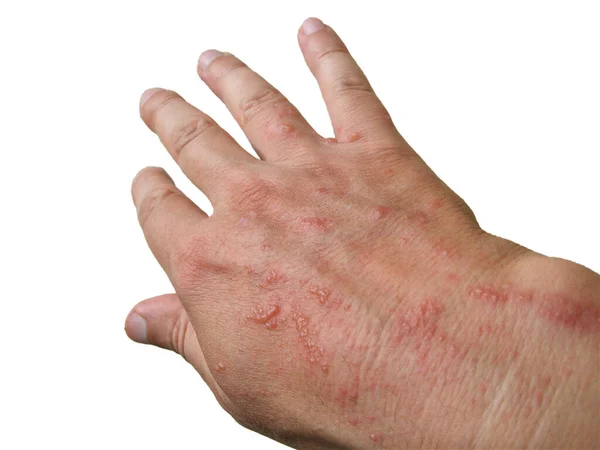 Chemical burn of the skin from dangerous plants. Man\'s hand has suffered from hogweed burn known as cow parsnips or giant cow parsley - the palm view on white background.