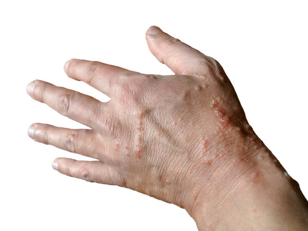 Пример химического ожога кожи руки, полученного от таких опасных растений, как свиноматки. Вид мужской ладони на белом фоне - кожа рук повреждена от ожога водорослями.
