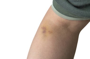 Dirsek kırışıklığının yanında gözle görülür bir deri altı morluğu var. Muhtemelen iğne sonrası oluşan bir komplikasyon ya da kan alma komplikasyonu..