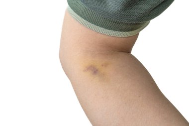 İç kol derisinde, venipunktur ya da damar içi kan alma prosedüründen kaynaklanan küçük bir tıbbi komplikasyondan kaynaklanan bir çürük var..